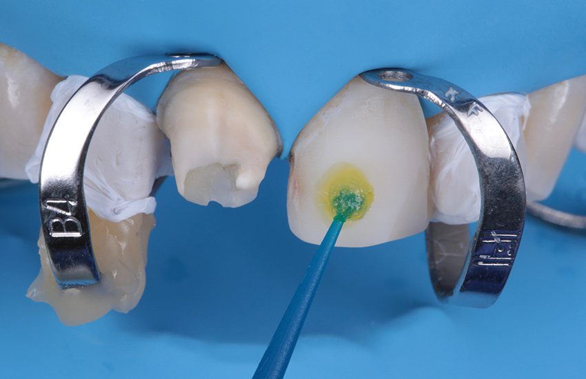 Auftragen von 3M™ Scotchbond™ Universal Plus Adhäsiv. Bilder mit freundlicher Genehmigung von Dr. Paulo Monteiro.